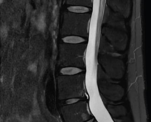 MRI scan of human lumbar spine showing vertebral discs and spinal cord in black and white.