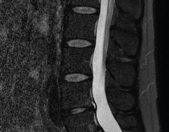 MRI scan of the lumbar spine showing vertebrae and spinal cord in a sagittal view.