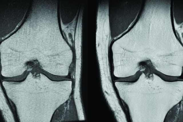 MRI scan of human knee joints, showing detailed bone and cartilage structure.